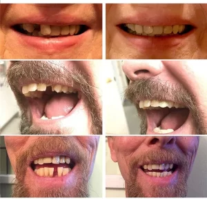 Instant smile - fogsor javító készlet vészhelyzet esetére - ideiglenes fogpótlás készítő (BBM) - 3. kép